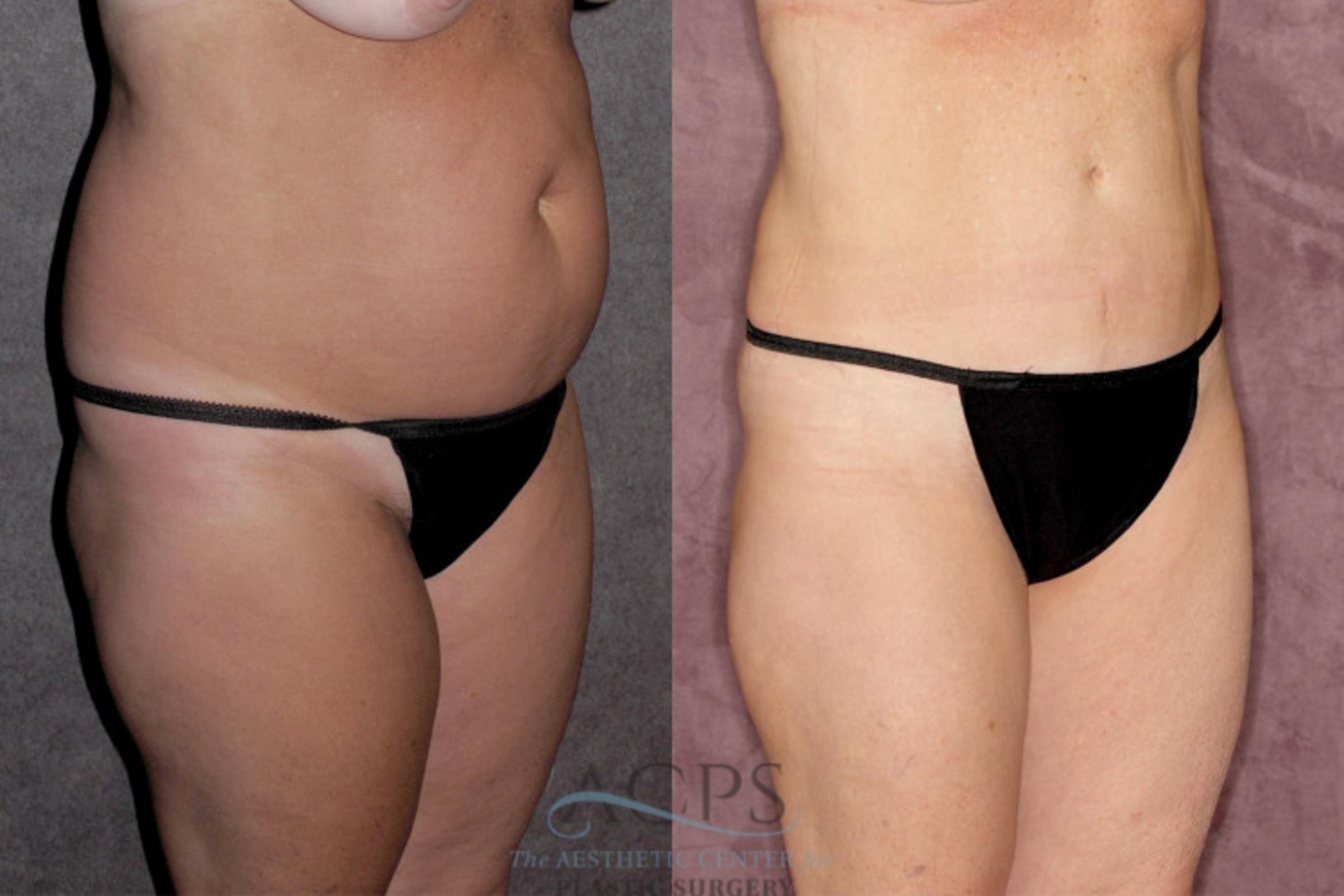 Before & After Tummy Tuck Case 29 Oblique Right View: View in Houston, TX