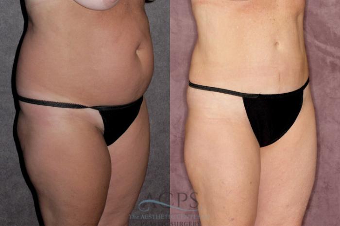 Before & After Tummy Tuck Case 29 Oblique Right View: View in Houston, TX