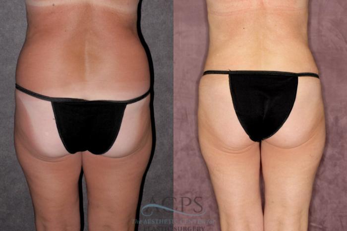 Before & After Tummy Tuck Case 29 Rear View: View in Houston, TX