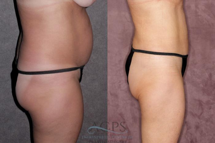 Before & After Tummy Tuck Case 29 Side Right View: View in Houston, TX
