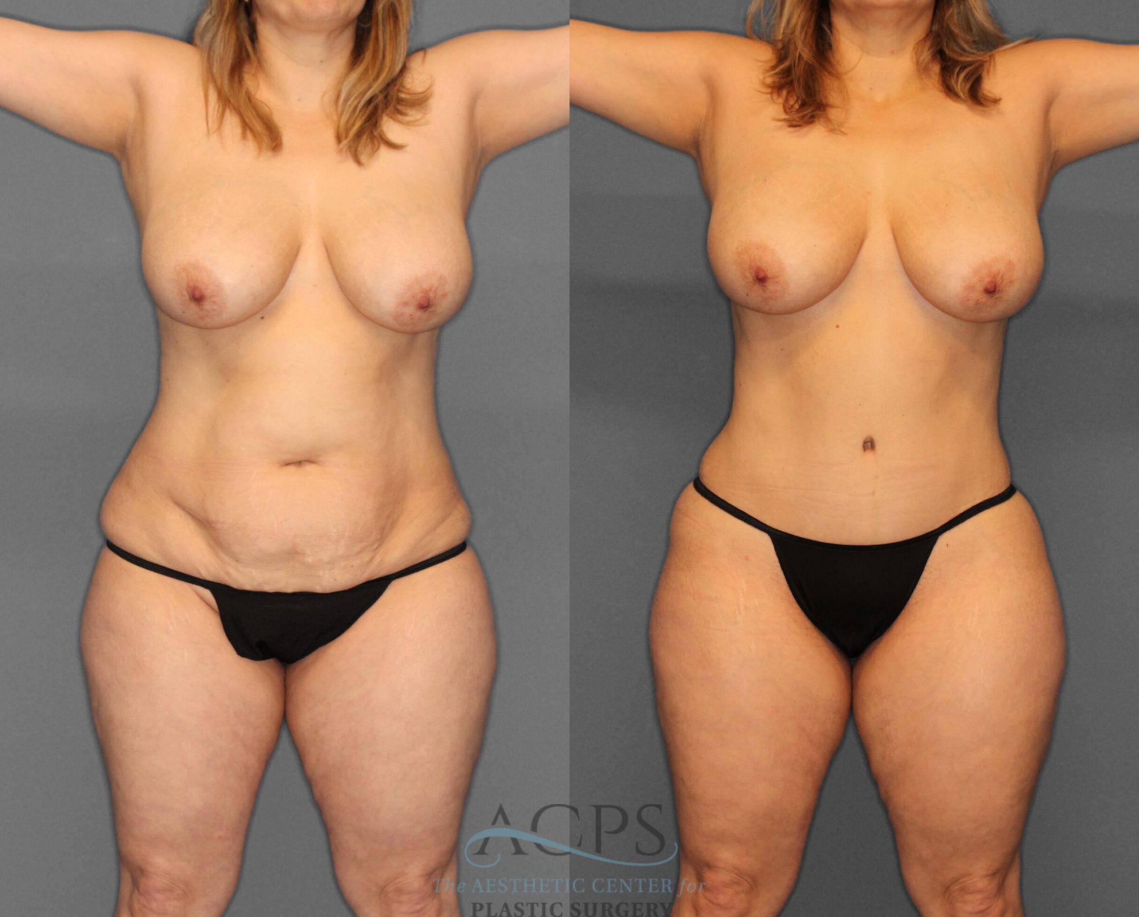 Before & After Tummy Tuck Case 3 Front View: View in Houston, TX