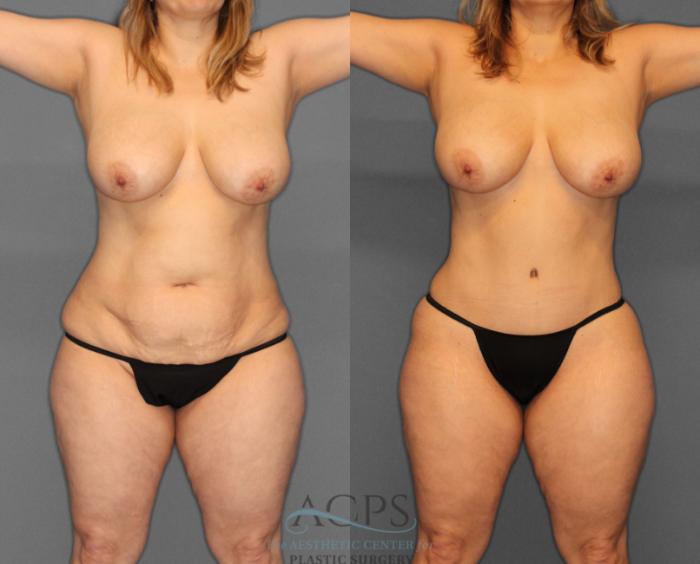 Before & After Tummy Tuck Case 3 Front View: View in Houston, TX