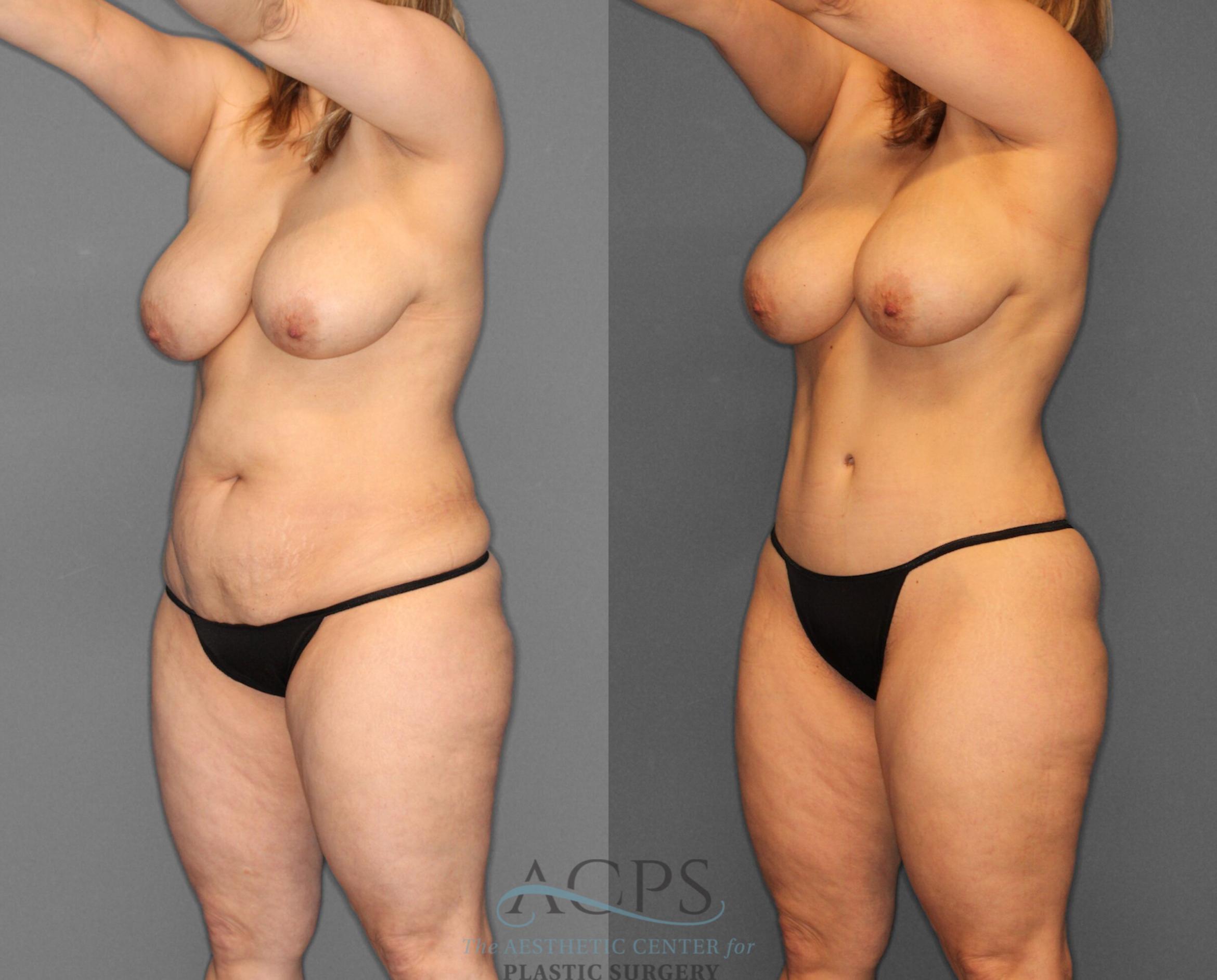 Before & After Tummy Tuck Case 3 Left Oblique View: View in Houston, TX