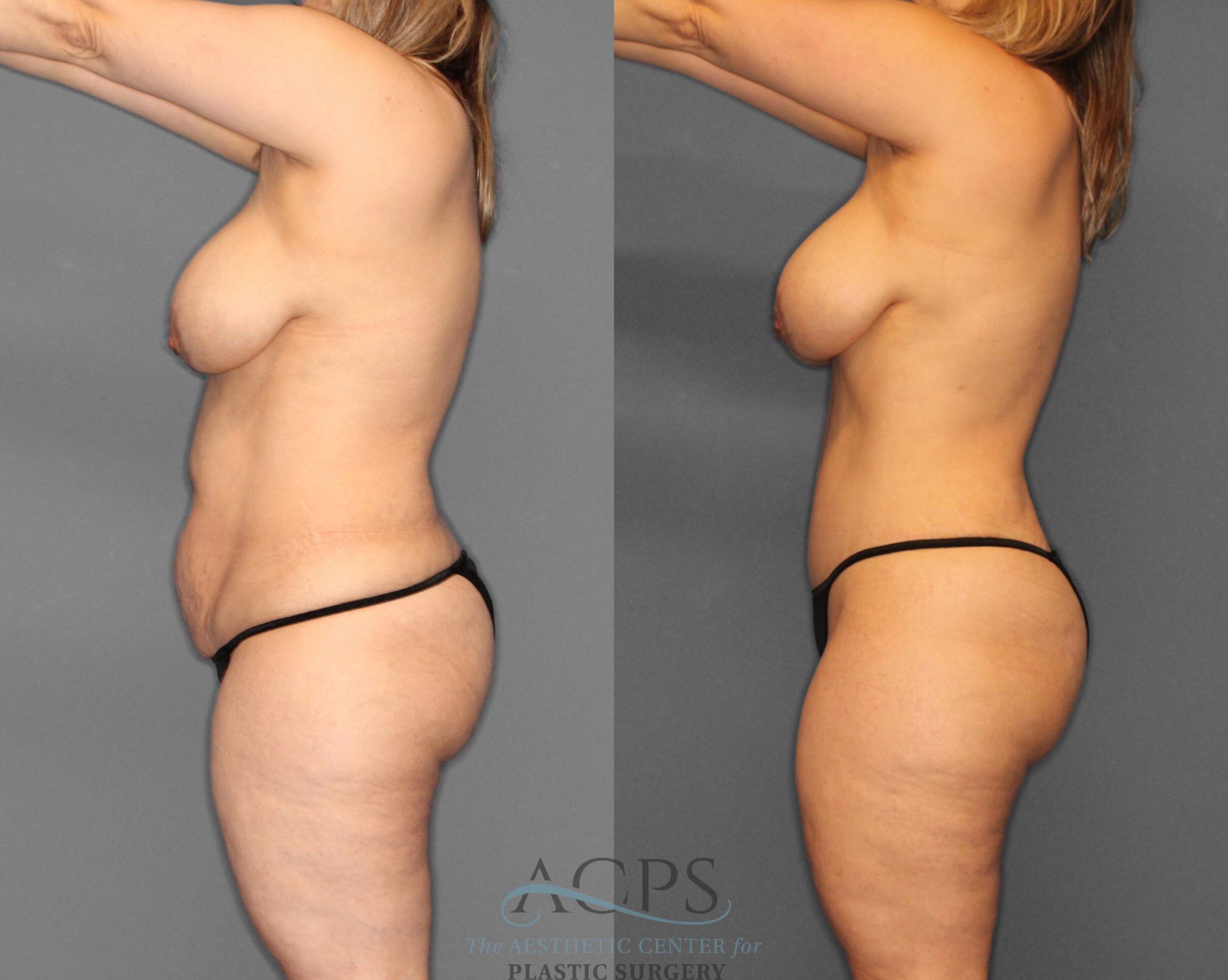 Before & After Tummy Tuck Case 3 Left Side View: View in Houston, TX