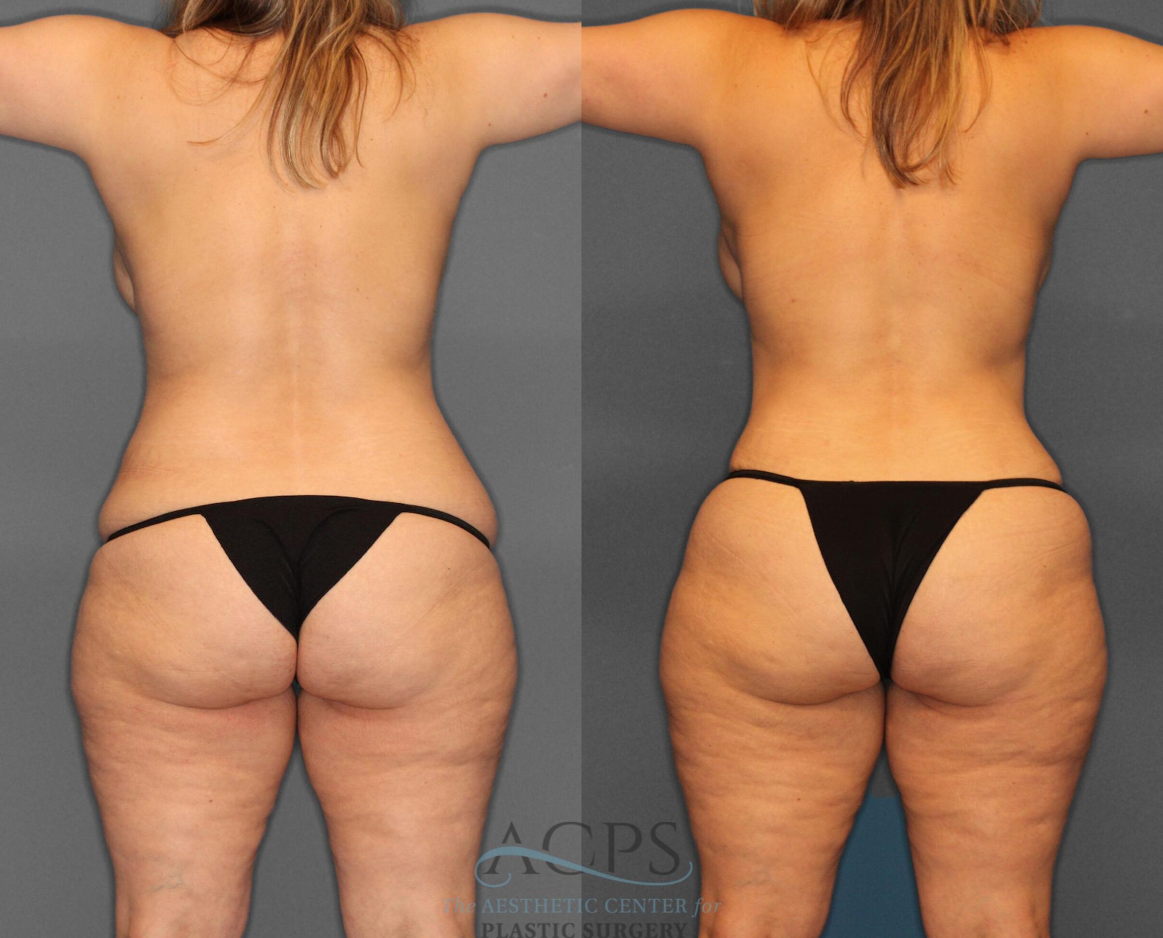 Before & After Tummy Tuck Case 3 Rear View: View in Houston, TX