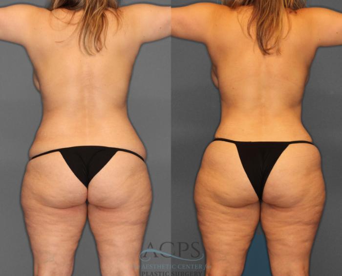 Before & After Tummy Tuck Case 3 Rear View: View in Houston, TX