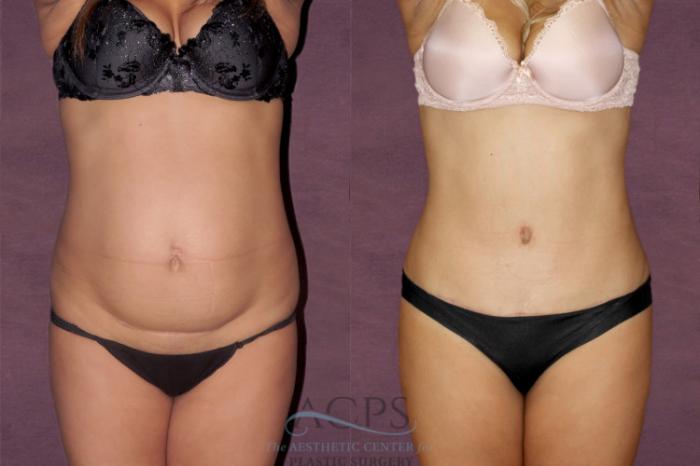 Before & After Liposuction Case 30 Front View: View in Houston, TX