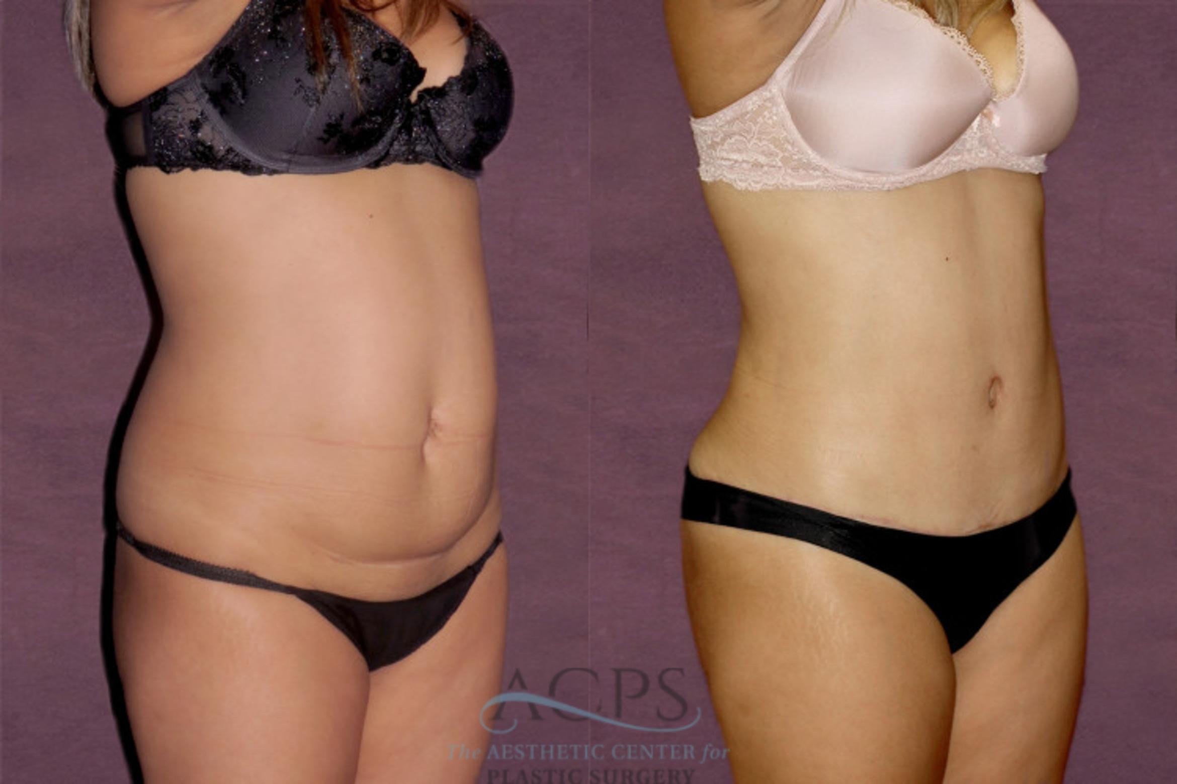 Before & After Liposuction Case 30 Oblique Right View: View in Houston, TX