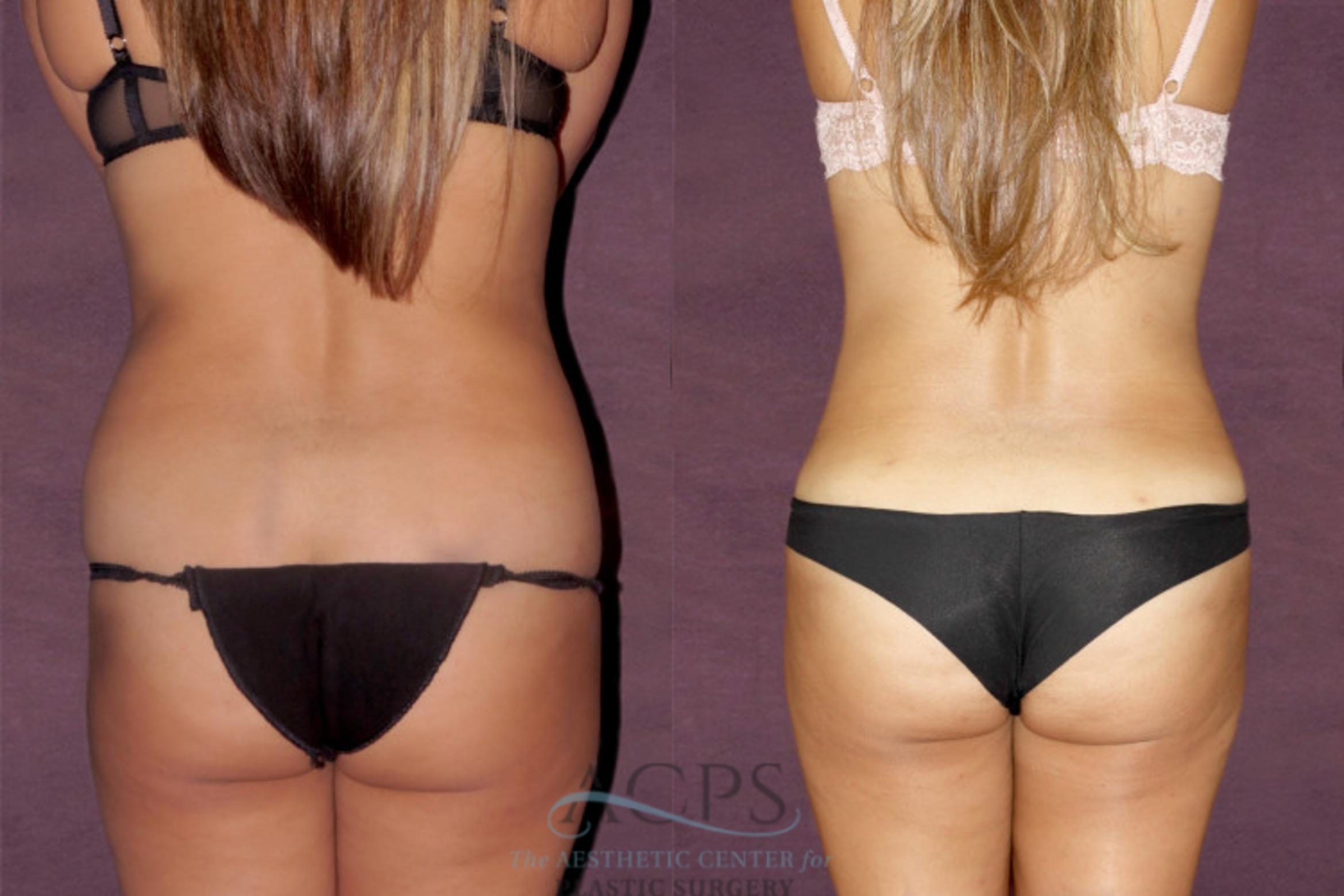 Before & After Liposuction Case 30 Rear View: View in Houston, TX