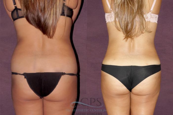 Before & After Liposuction Case 30 Rear View: View in Houston, TX