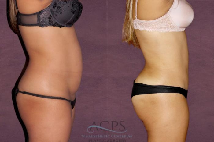 Before & After Liposuction Case 30 Side Right View: View in Houston, TX