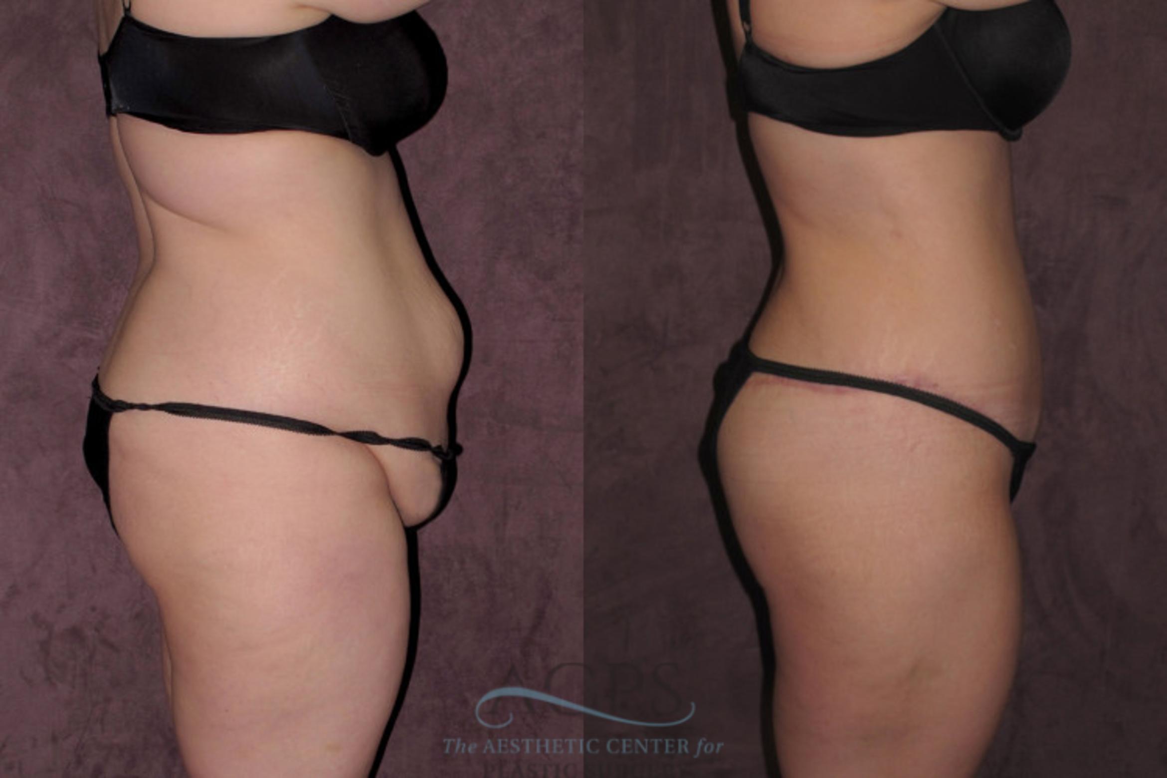 Before & After Tummy Tuck Case 31 Back Right View: View in Houston, TX
