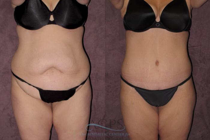Before & After Tummy Tuck Case 31 Front View: View in Houston, TX