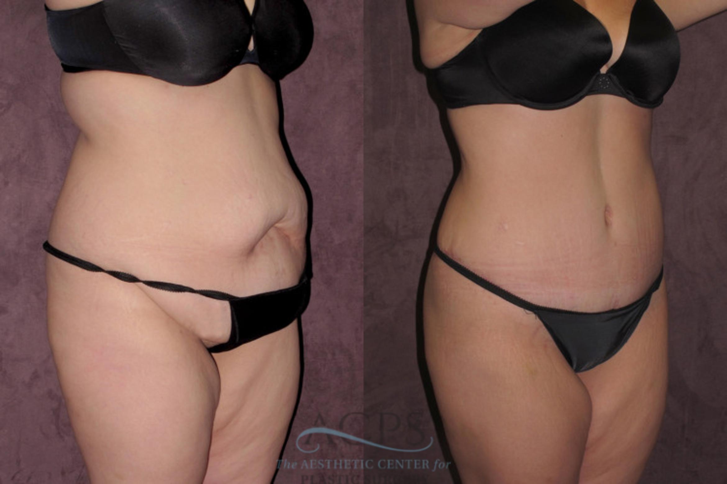 Before & After Tummy Tuck Case 31 Oblique Right View: View in Houston, TX