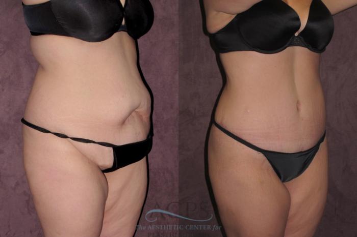 Before & After Tummy Tuck Case 31 Oblique Right View: View in Houston, TX