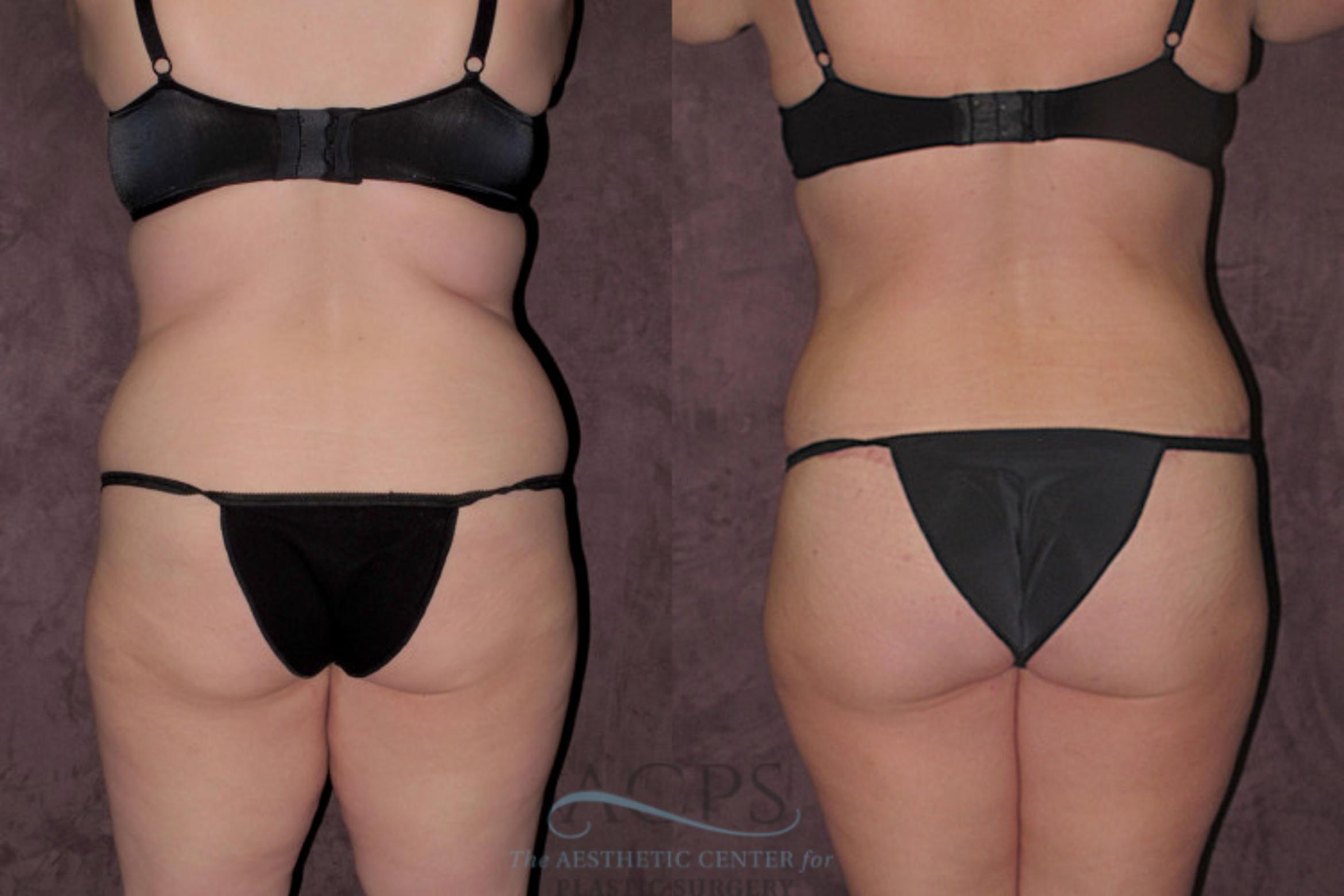 Before & After Tummy Tuck Case 31 Rear View: View in Houston, TX