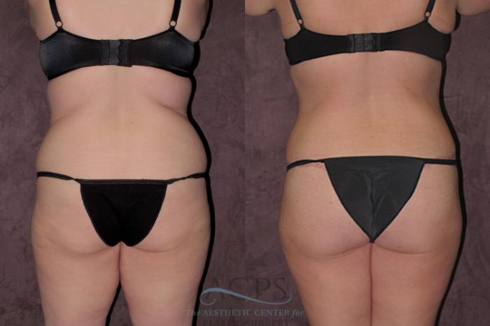 Before & After Tummy Tuck Case 31 Rear View: View in Houston, TX