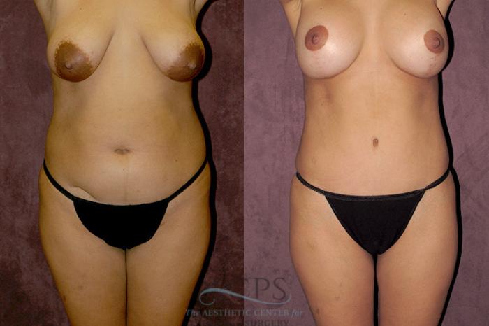 Before & After Tummy Tuck Case 32 Front View: View in Houston, TX