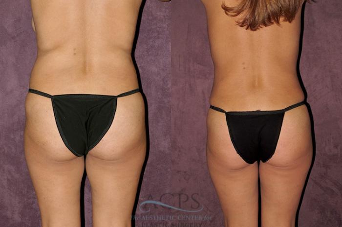 Before & After Tummy Tuck Case 32 Rear View: View in Houston, TX