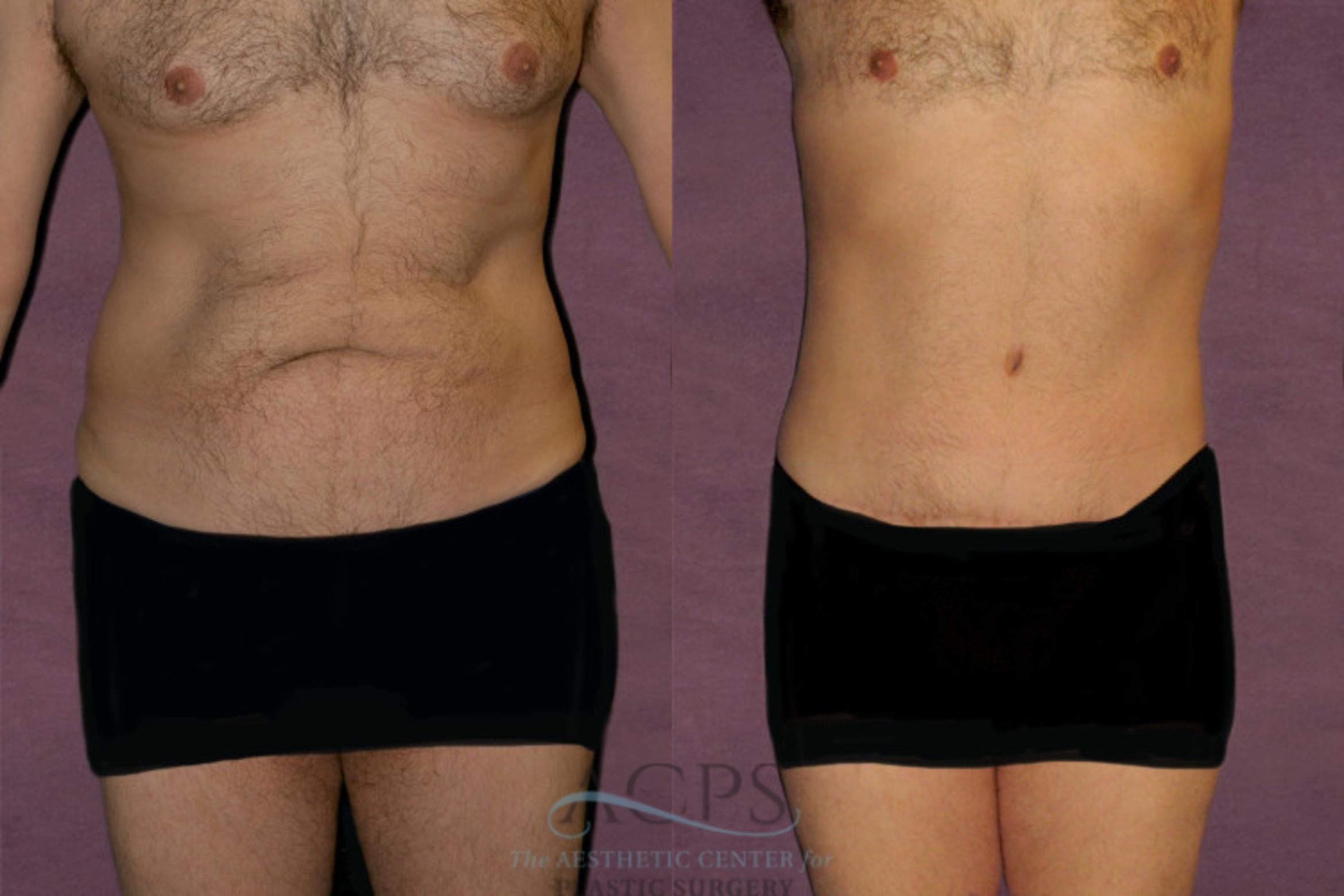 Before & After Tummy Tuck Case 33 Front View: View in Houston, TX