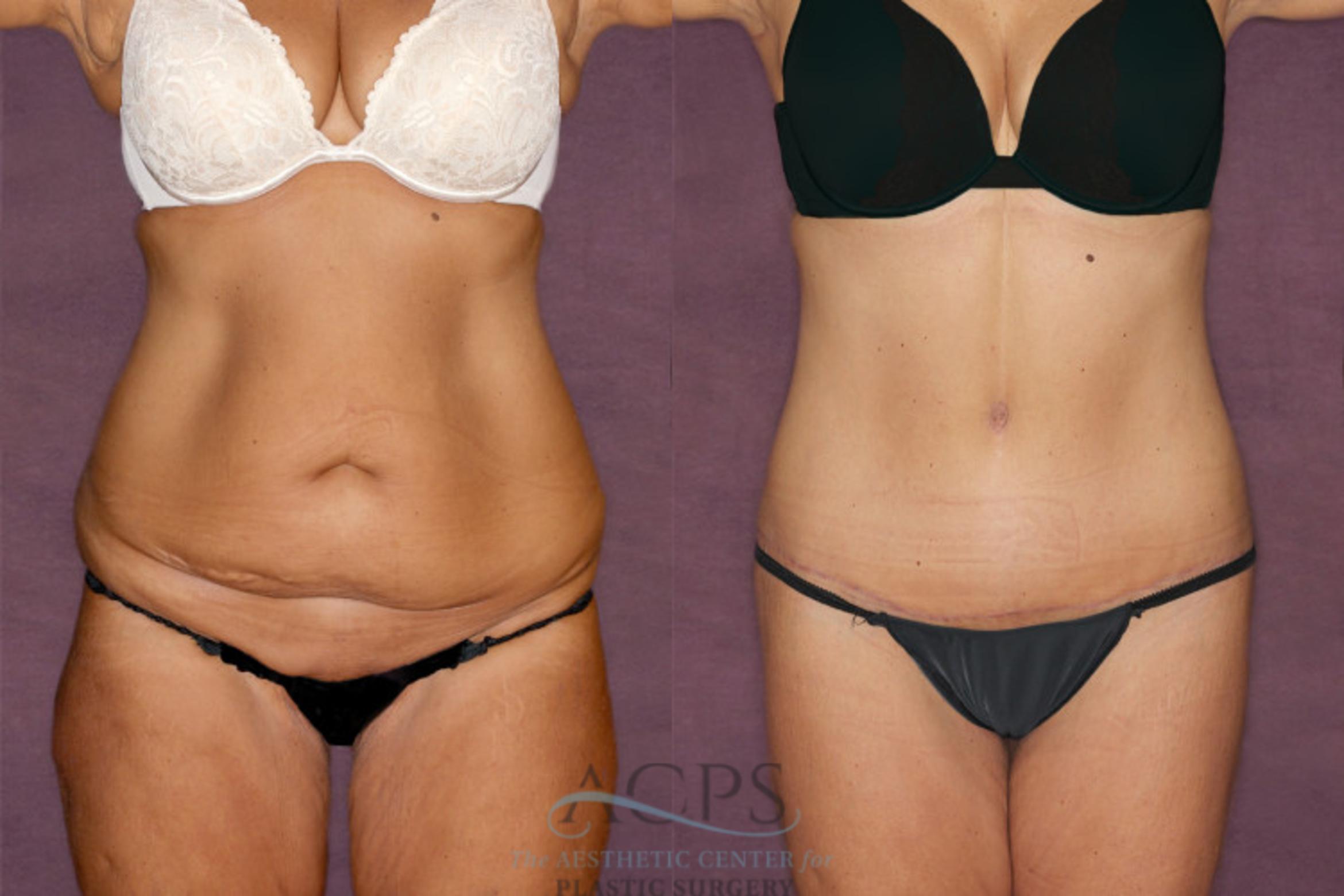 Before & After Tummy Tuck Case 34 Front View: View in Houston, TX