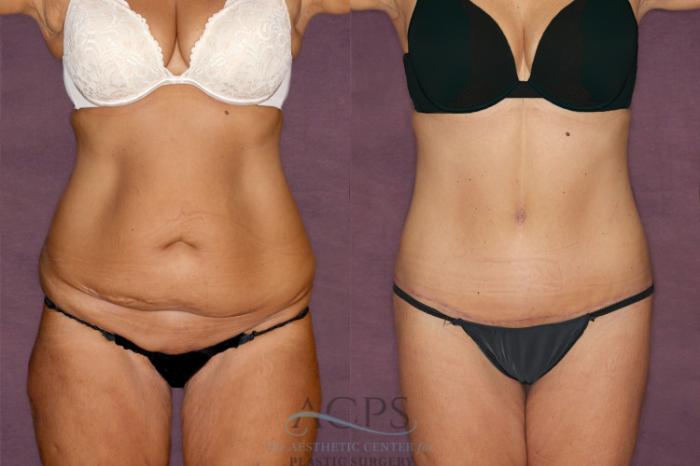 Before & After Tummy Tuck Case 34 Front View: View in Houston, TX