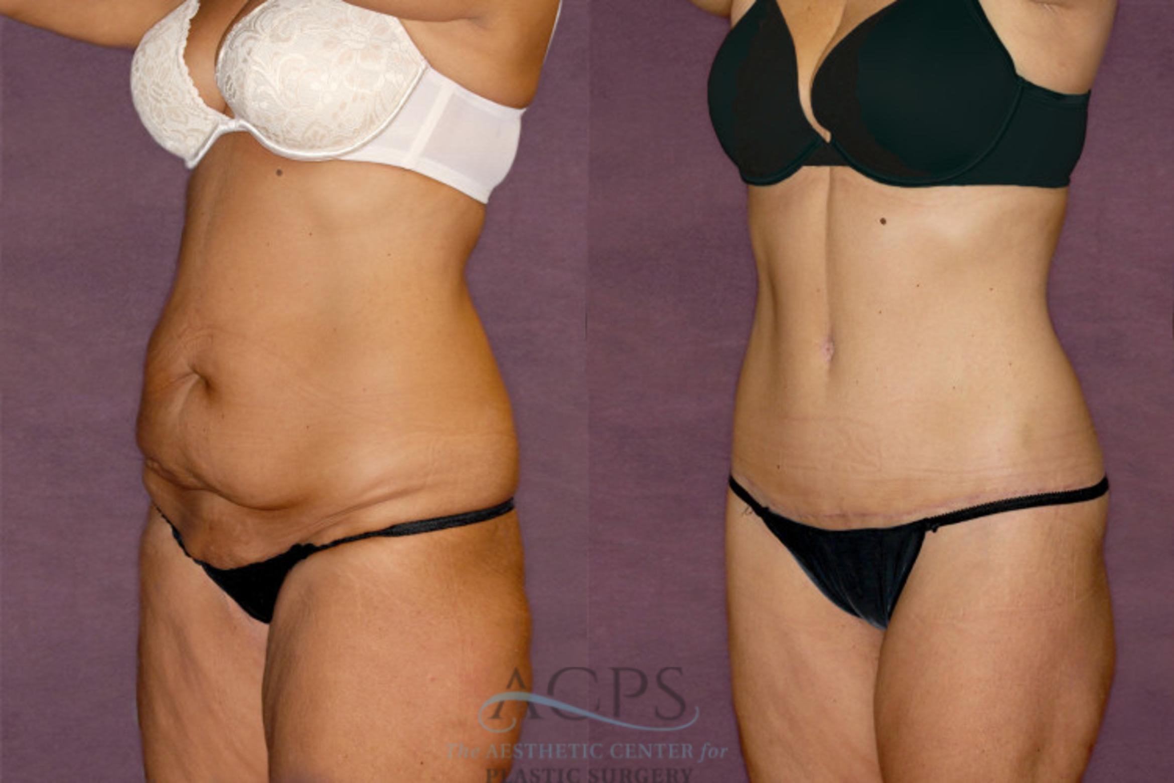 Before & After Tummy Tuck Case 34 Oblique Left View: View in Houston, TX
