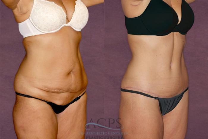 Before & After Tummy Tuck Case 34 Oblique Right View: View in Houston, TX