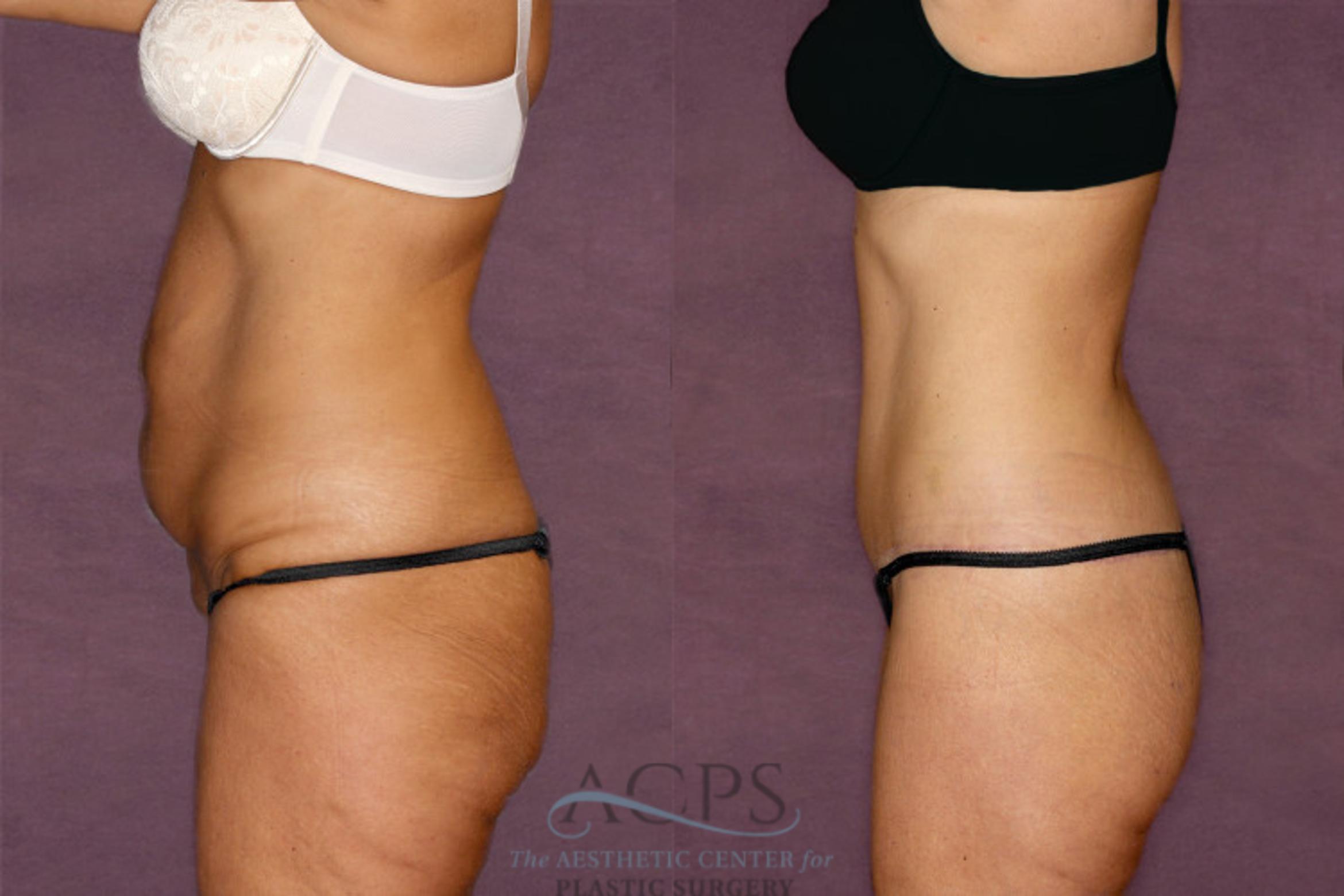 Before & After Tummy Tuck Case 34 Side Left View: View in Houston, TX