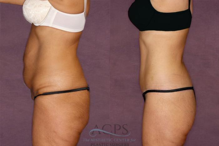 Before & After Tummy Tuck Case 34 Side Left View: View in Houston, TX