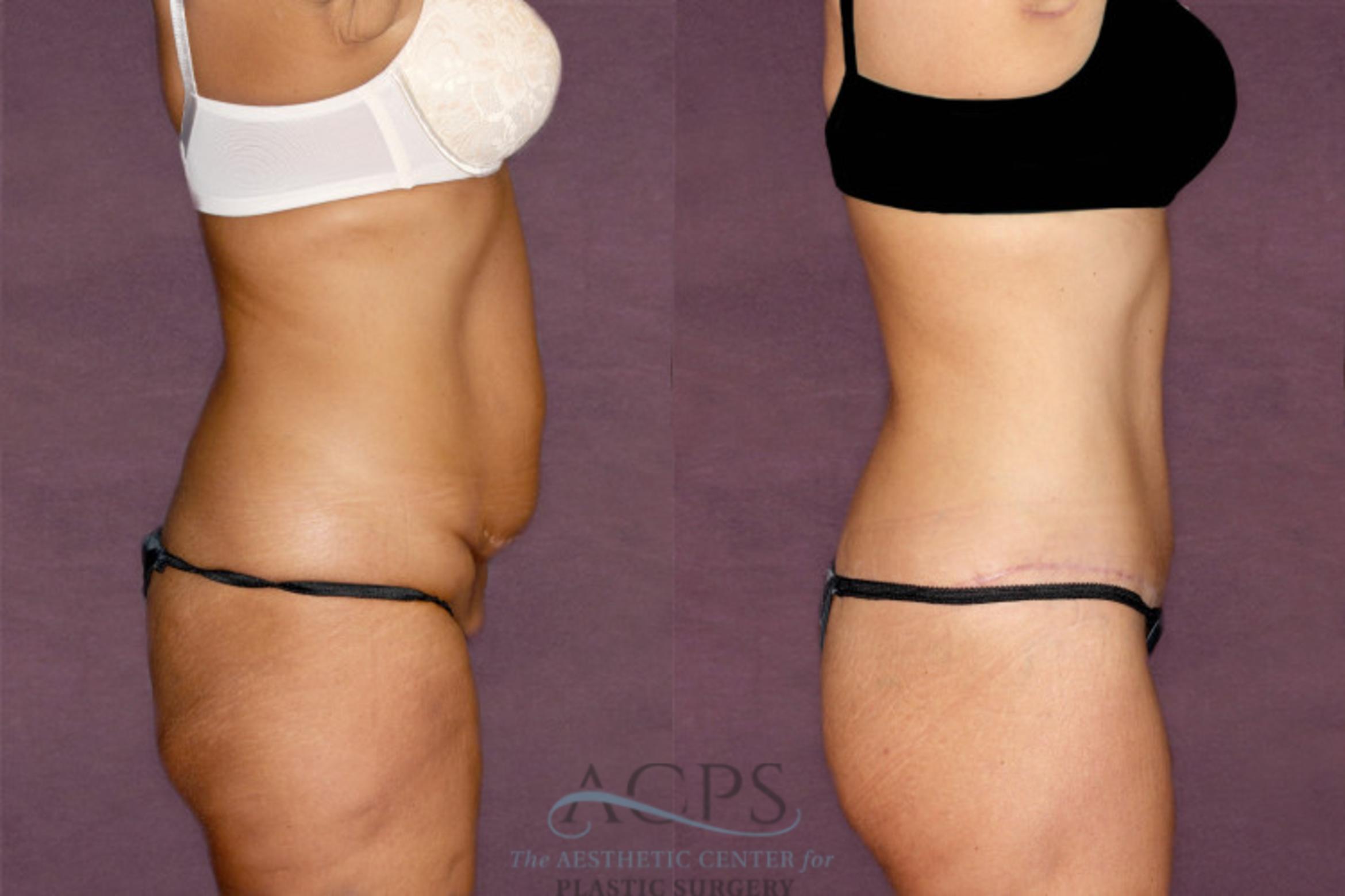 Before & After Tummy Tuck Case 34 Side Right View: View in Houston, TX