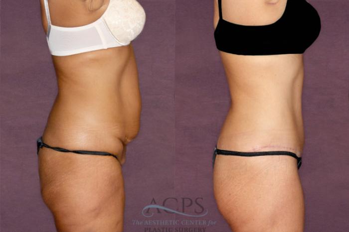 Before & After Tummy Tuck Case 34 Side Right View: View in Houston, TX