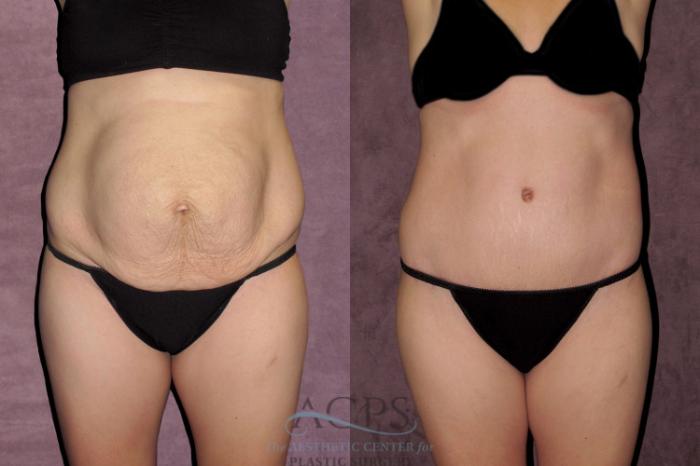 Before & After Tummy Tuck Case 35 Front View: View in Houston, TX
