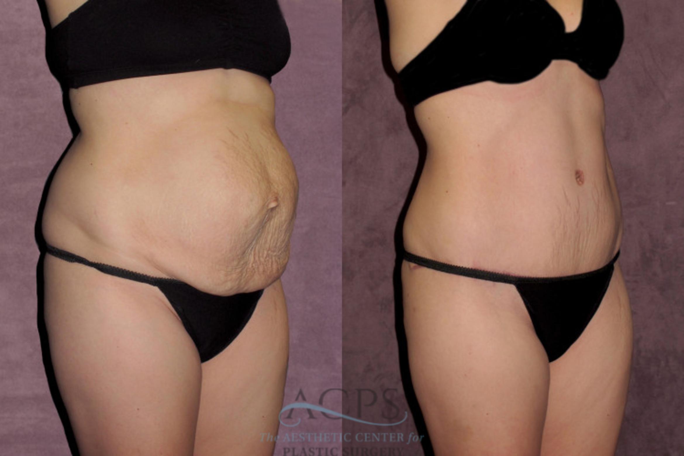 Before & After Tummy Tuck Case 35 Oblique Right View: View in Houston, TX