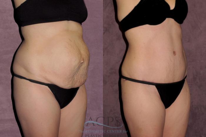 Before & After Tummy Tuck Case 35 Oblique Right View: View in Houston, TX