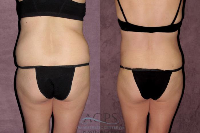 Before & After Tummy Tuck Case 35 Rear View: View in Houston, TX