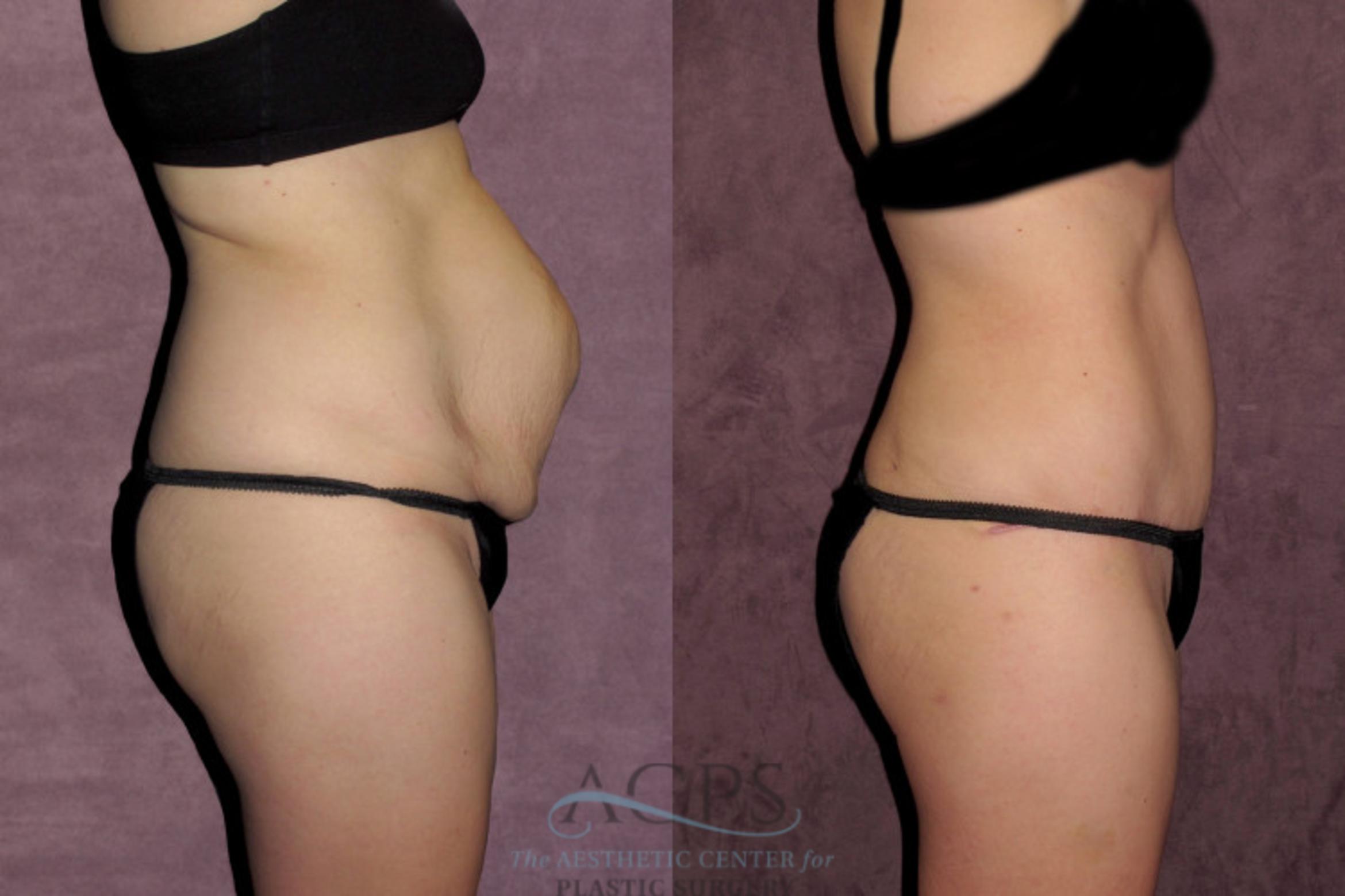 Before & After Tummy Tuck Case 35 Side Right View: View in Houston, TX