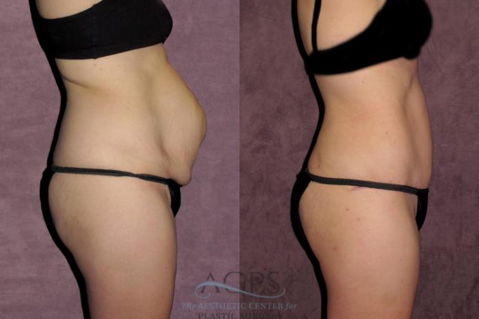 Before & After Tummy Tuck Case 35 Side Right View: View in Houston, TX