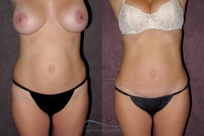 Before & After Tummy Tuck Case 36 Front View: View in Houston, TX