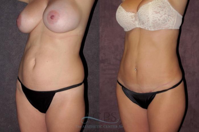 Before & After Tummy Tuck Case 36 Oblique Left View: View in Houston, TX