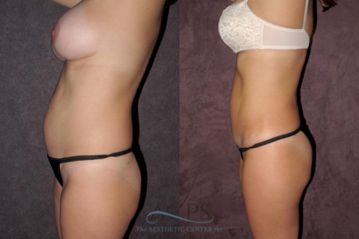 Before & After Tummy Tuck Case 36 Side Left View: View in Houston, TX