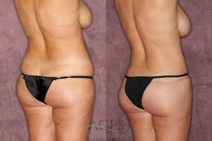 Before & After Brazilian Butt Lift (BBL) Case 37 Back Right View: View in Houston, TX