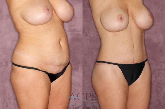 Before & After Brazilian Butt Lift (BBL) Case 37 Oblique Right View: View in Houston, TX