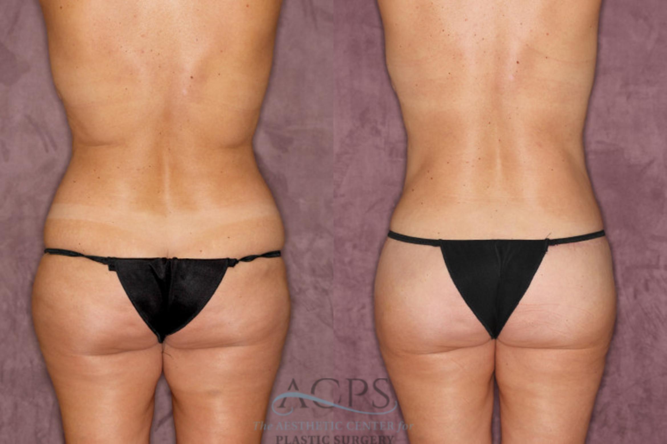 Before & After Brazilian Butt Lift (BBL) Case 37 Rear View: View in Houston, TX