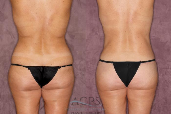 Before & After Brazilian Butt Lift (BBL) Case 37 Rear View: View in Houston, TX