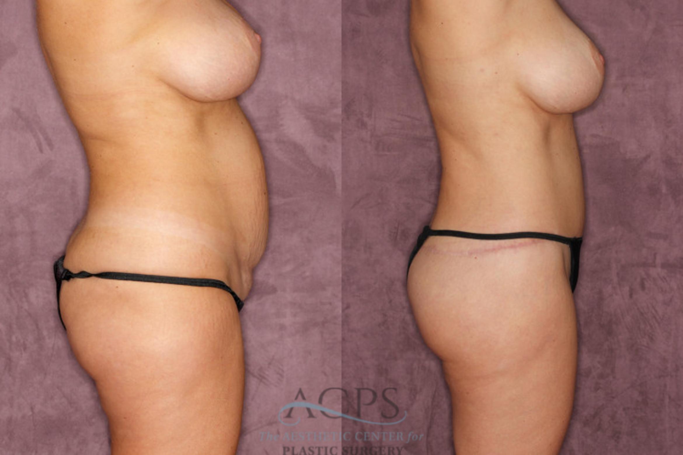 Before & After Brazilian Butt Lift (BBL) Case 37 Side Right View: View in Houston, TX