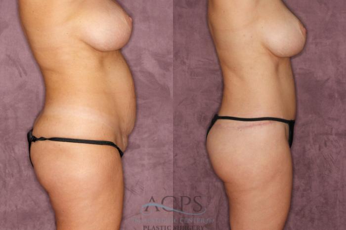 Before & After Brazilian Butt Lift (BBL) Case 37 Side Right View: View in Houston, TX