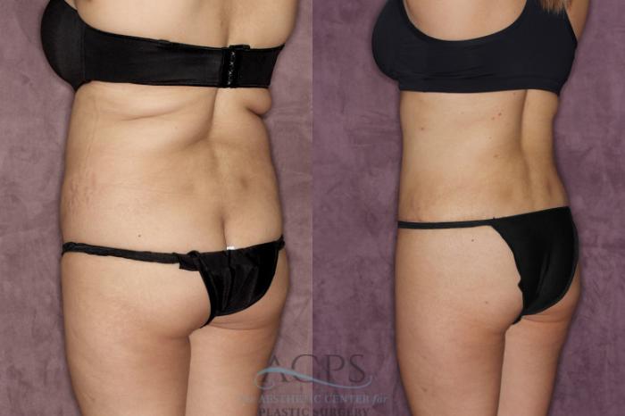 Before & After Tummy Tuck Case 38 Back Left View: View in Houston, TX