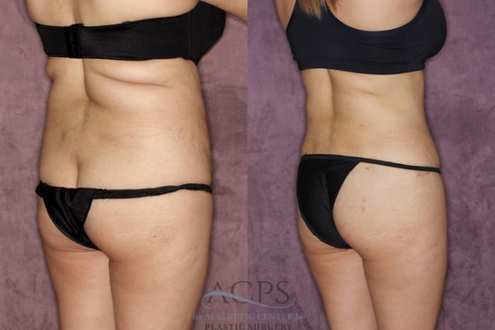 Before & After Tummy Tuck Case 38 Back Right View: View in Houston, TX