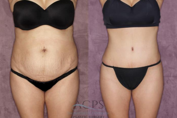 Before & After Tummy Tuck Case 38 Front View: View in Houston, TX